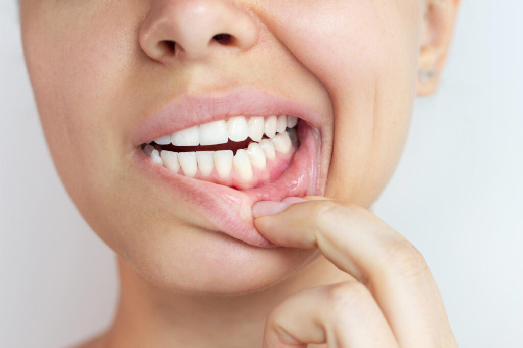 Por qué sangran las encías y cuándo deberías acudir al dentista