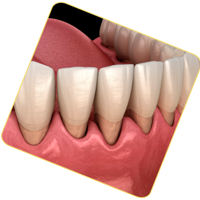 periodonditis